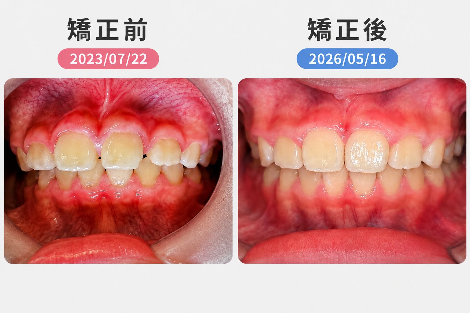 兒童肌功能矯正案例