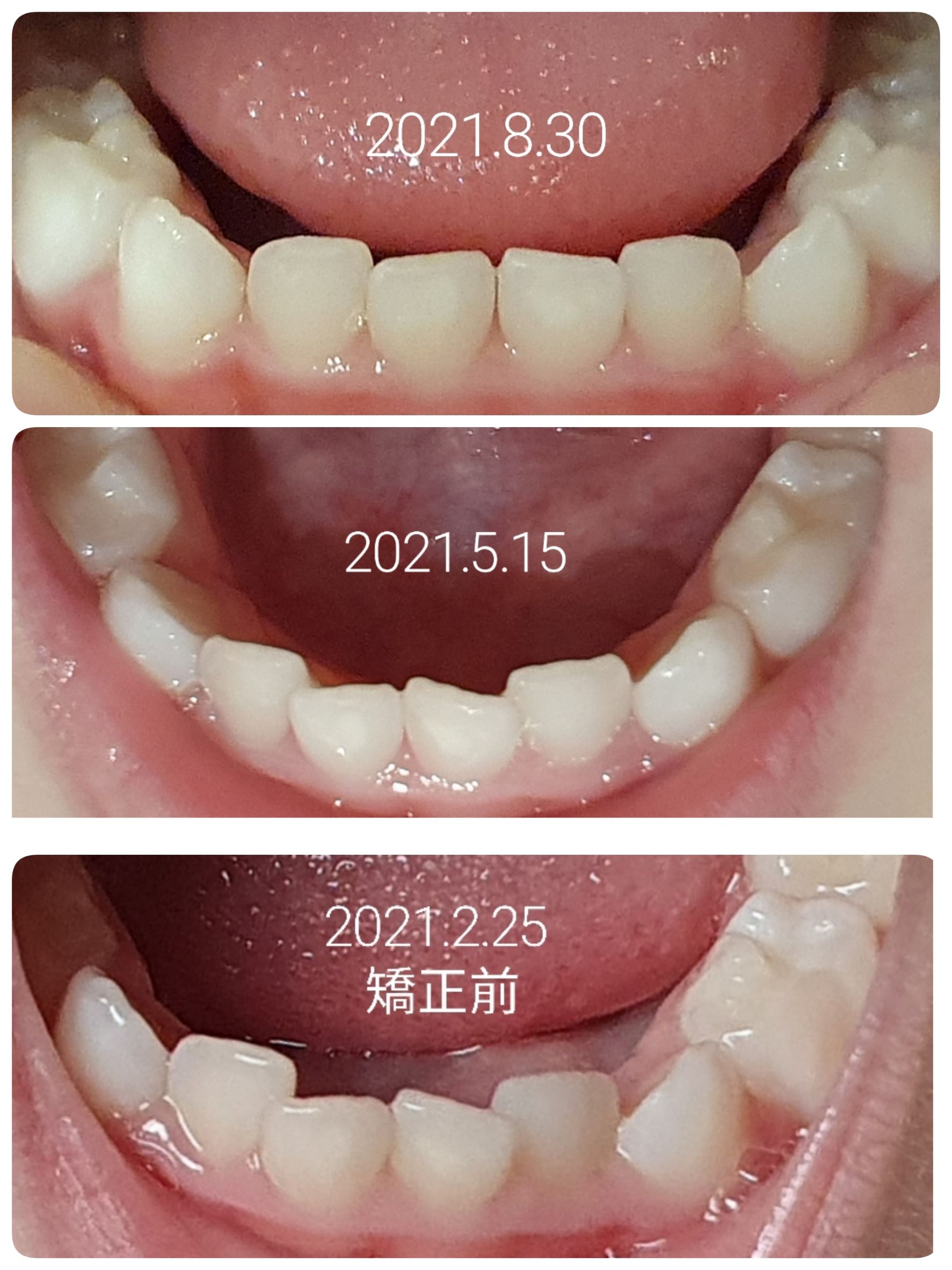 兒童肌功能矯正案例