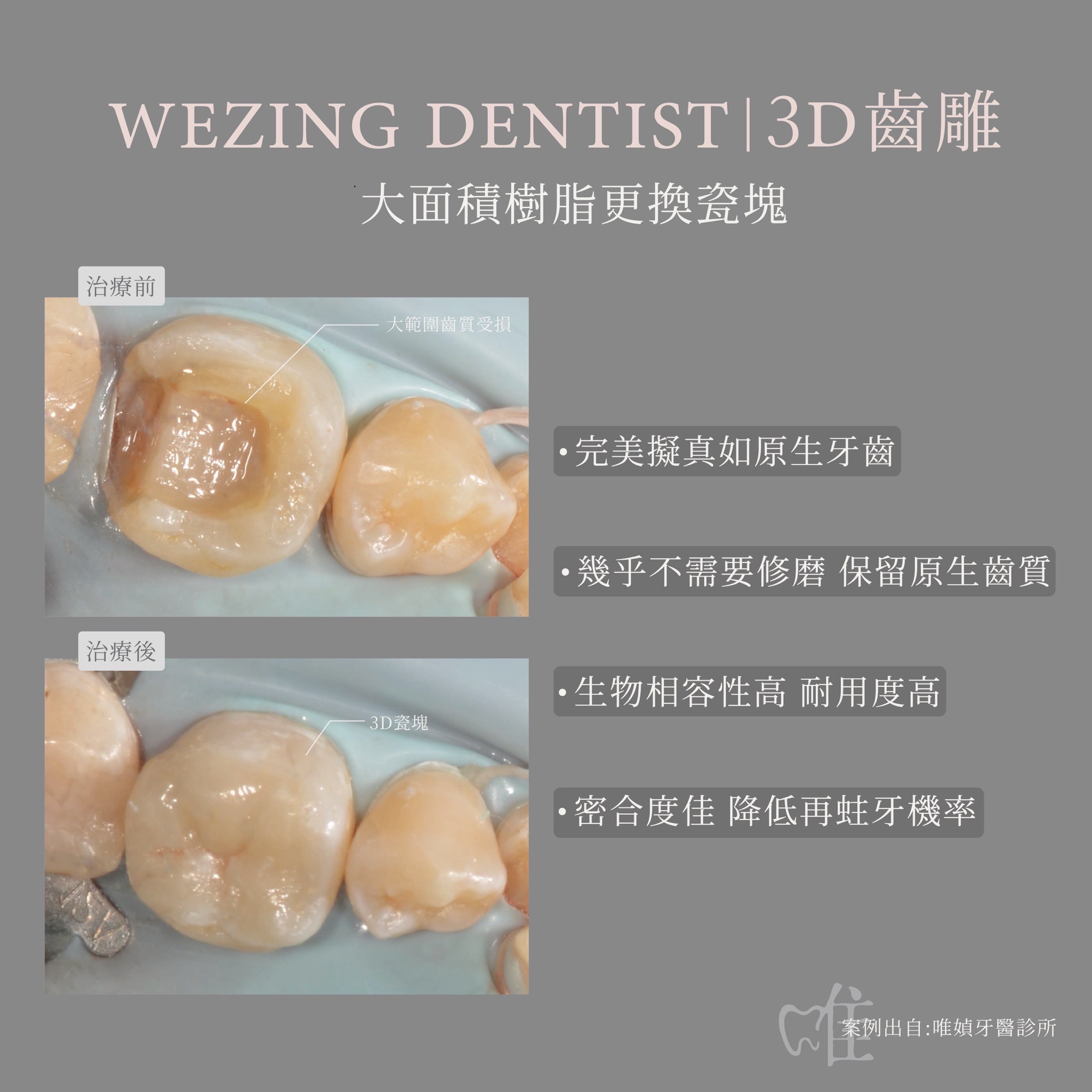 3D齒雕